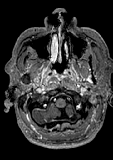 Accessory middle cerebral artery (Radiopaedia 73114-83828 Axial T1 C+ 180).jpg