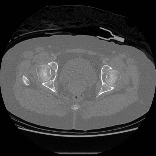File:Acetabular fracture (Radiopaedia 13193-13212 Axial bone window 26).jpg