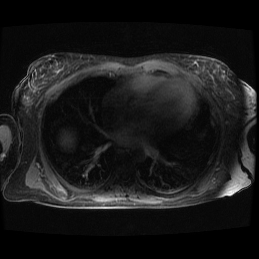 Acinar cell carcinoma of the pancreas (Radiopaedia 75442-86668 Axial late phase (~30 mins) 147).jpg