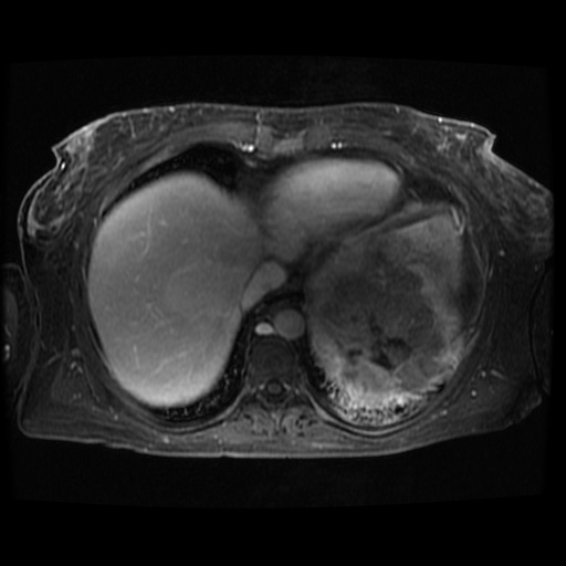 Acinar cell carcinoma of the pancreas (Radiopaedia 75442-86668 D 128).jpg