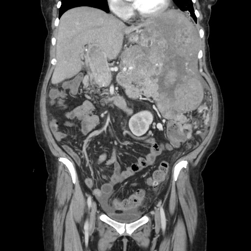 Acinar cell carcinoma of the pancreas (Radiopaedia 75442-86669 Coronal C+ portal venous phase 52).jpg
