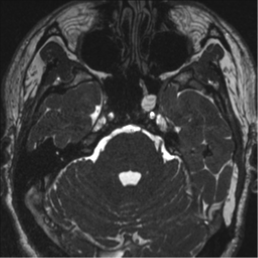 Acoustic schwannoma (translabyrinthine resection) (Radiopaedia 43570-46972 Axial CISS 38).png