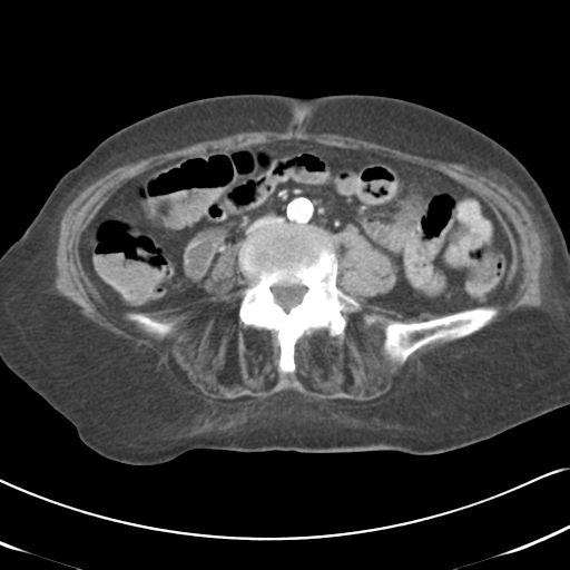 File:Active bleeding from duodenal ulcer with embolization (Radiopaedia 34216-35481 C 37).png