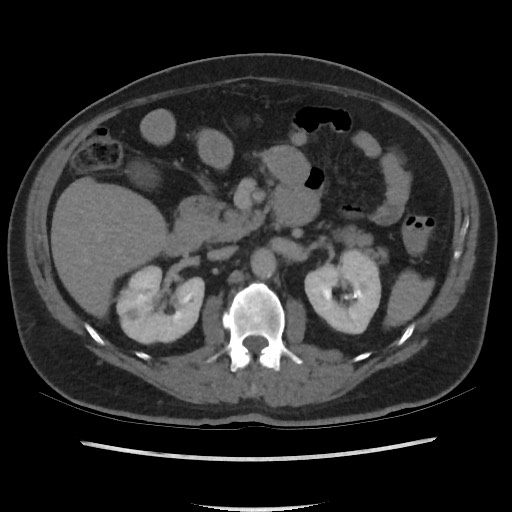 File:Active colonic bleed on CT (Radiopaedia 49765-55025 Axial C+ delayed 32).jpg