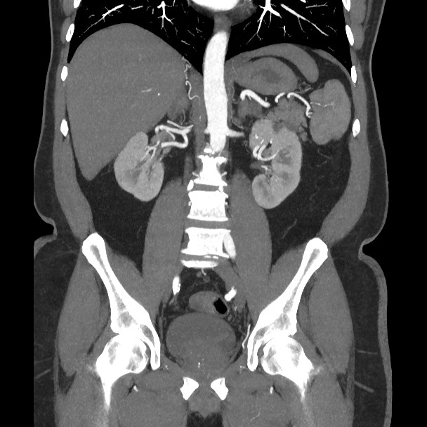 Active colonic bleed on CT (Radiopaedia 49765-55025 Coronal art MIP 37).jpg