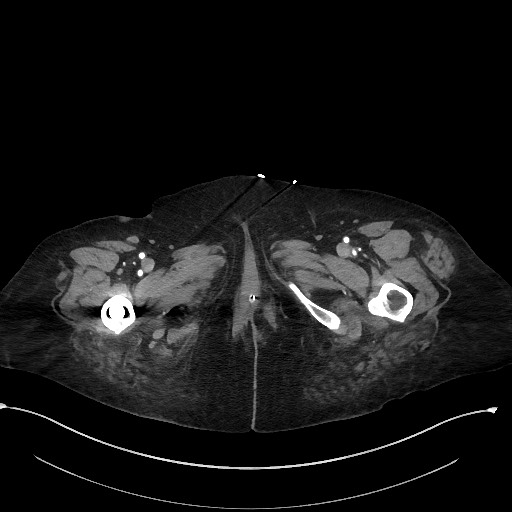 Active renal extravasation with large subcapsular and retroperitoneal hemorrhage (Radiopaedia 60975-68796 Axial C+ arterial phase 217).jpg