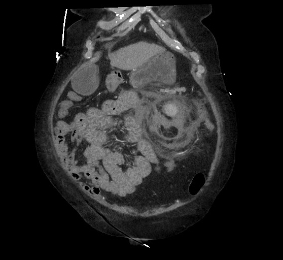Active renal extravasation with large subcapsular and retroperitoneal hemorrhage (Radiopaedia 60975-68796 Coronal C+ arterial phase 40).jpg