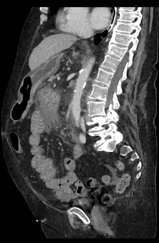 Active renal extravasation with large subcapsular and retroperitoneal hemorrhage (Radiopaedia 60975-68796 Sagittal C+ portal venous phase 123).jpg