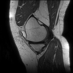 File:Acute-on-chronic transient lateral patellar dislocation with trochlear dysplasia (Radiopaedia 84099-99349 Sagittal PD 44).jpg