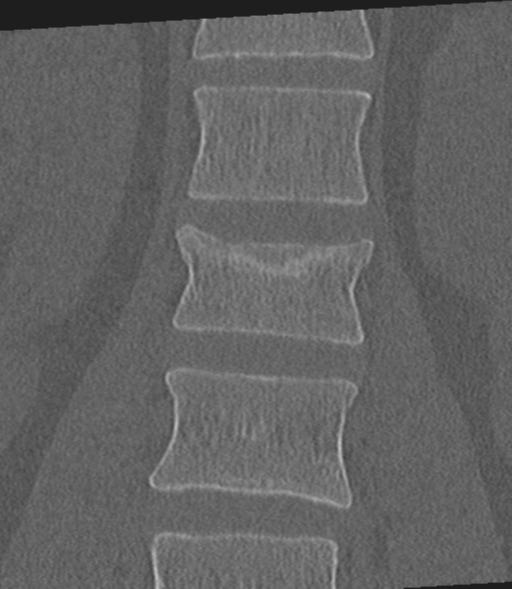 File:Acute L1 burst compression fracture (Radiopaedia 34430-35755 Coronal bone window 25).png