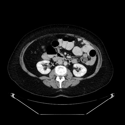 Acute appendicitis, heterotaxy syndrome (Radiopaedia 66884-76202 Axial C+ portal venous phase 59).jpg