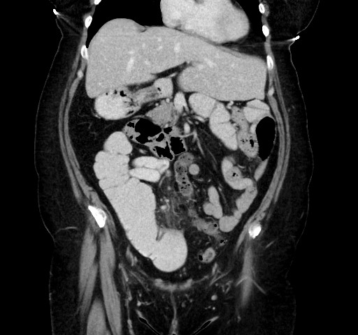 Acute appendicitis, heterotaxy syndrome (Radiopaedia 66884-76202 Coronal C+ portal venous phase 43).jpg