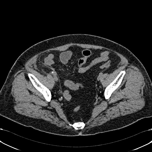 Acute appendicitis (Radiopaedia 58627-65818 Axial non-contrast 73).jpg