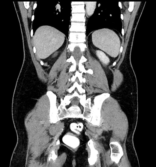 Acute appendicitis (Radiopaedia 77016-88960 Coronal C+ portal venous phase 74).jpg
