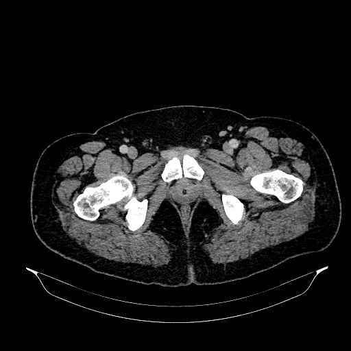 File:Acute appendicitis (Radiopaedia 79950-93224 Axial C+ portal venous phase 102).jpg