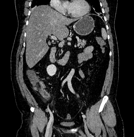 Acute appendicitis (Radiopaedia 79950-93224 Coronal C+ portal venous phase 43).jpg