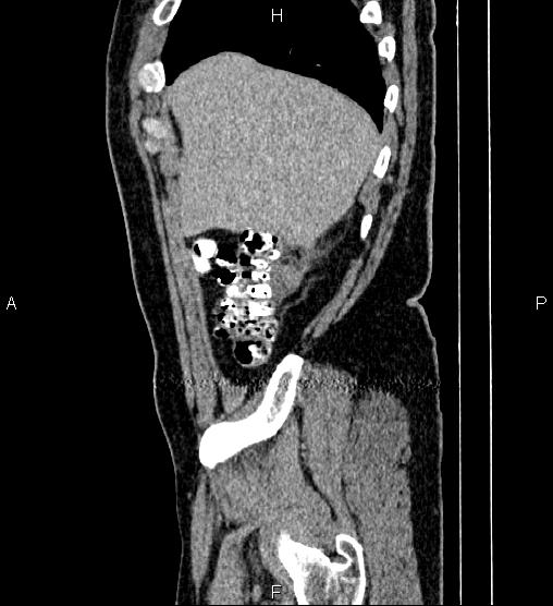 Acute appendicitis (Radiopaedia 84780-100240 Sagittal C+ portal venous phase 12).jpg