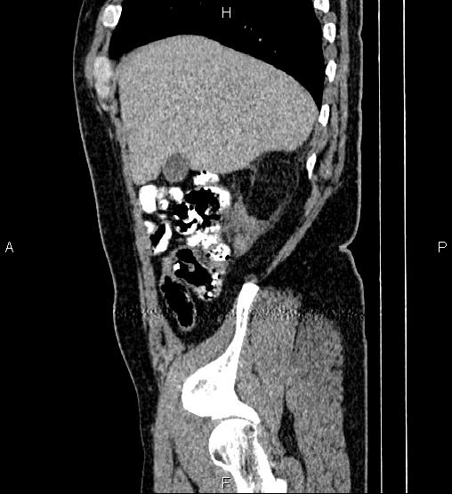Acute appendicitis (Radiopaedia 84780-100240 Sagittal C+ portal venous phase 17).jpg