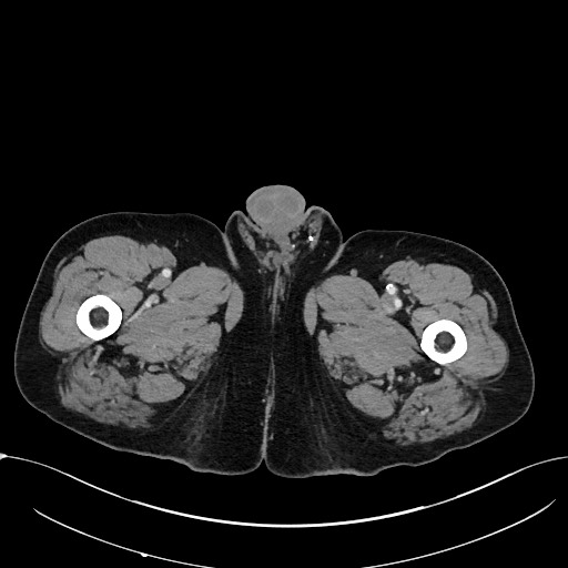File:Acute appendicitis - large appendicoliths (Radiopaedia 61805-69820 Axial C+ portal venous phase 157).jpg