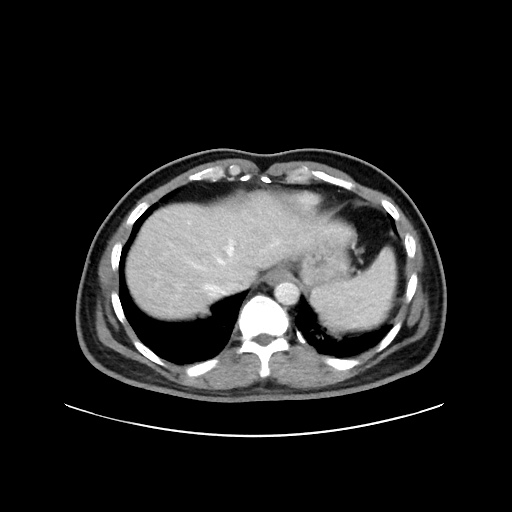 Acute appendicitis and COVID 19 pneumonia (Radiopaedia 76604-88380 Axial C+ portal venous phase 10).jpg