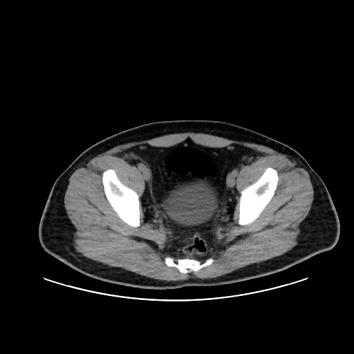 Acute appendicitis and COVID 19 pneumonia (Radiopaedia 76604-88380 Axial non-contrast 110).jpg