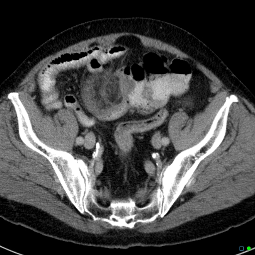 File:Acute appendicitis arising from a malrotated cecum (Radiopaedia 19970-19997 Axial C+ portal venous phase 37).jpg