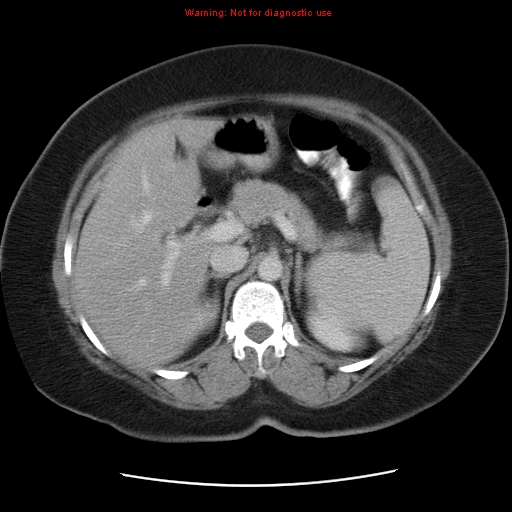 Acute appendicitis complicated by ovarian vein thrombophlebitis (Radiopaedia 16172-15851 Axial C+ portal venous phase 31).jpg
