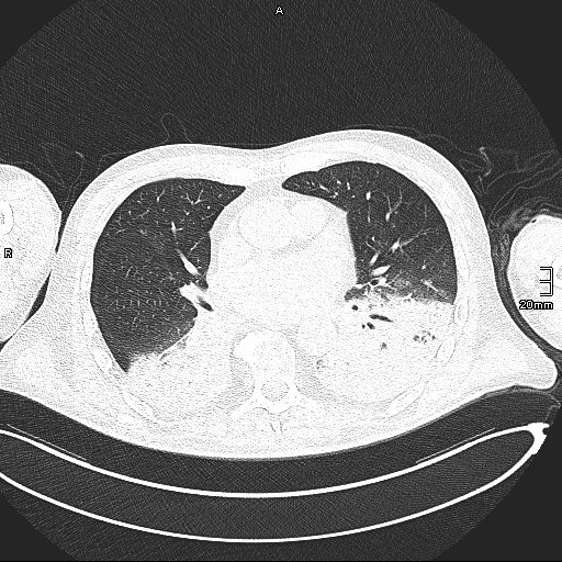 Acute aspiration pneumonitis (Radiopaedia 55642-62166 Axial lung window 87).jpg