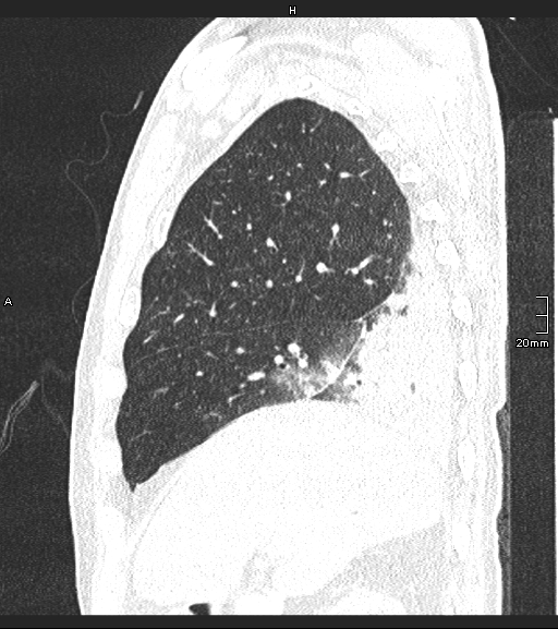 Acute aspiration pneumonitis (Radiopaedia 55642-62166 Sagittal lung window 115).jpg
