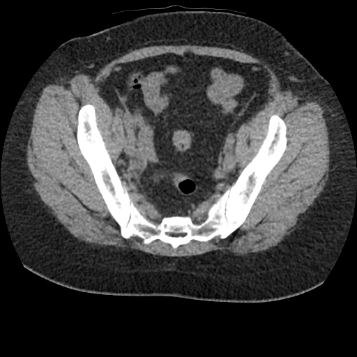 Acute cholecystitis and ureteric colic (Radiopaedia 42330-45444 Axial prone 89).jpg