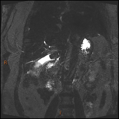 File:Acute cholecystitis with gallbladder neck calculus (Radiopaedia 42795-45971 Coronal Turbo spin echo 14).jpg