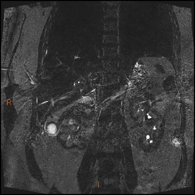 File:Acute cholecystitis with gallbladder neck calculus (Radiopaedia 42795-45971 Coronal Turbo spin echo 3).jpg