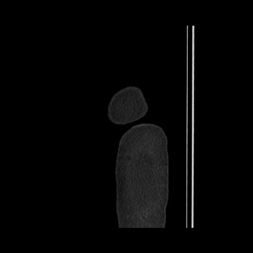 File:Acute cholecystitis with tensile fundus sign (Radiopaedia 71394-81723 Sagittal non-contrast 12).jpg
