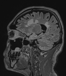 File:Acute disseminated encephalomyelitis (ADEM)- Anti-NMDA receptor encephalitis (Radiopaedia 54920-61201 Sagittal FLAIR 55).png