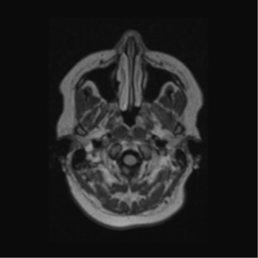 Acute disseminated encephalomyelitis (ADEM) (Radiopaedia 38073-40065 Axial FLAIR 2).png