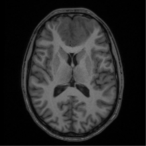 Acute disseminated encephalomyelitis (ADEM) (Radiopaedia 65319-74349 Axial T1 36).png