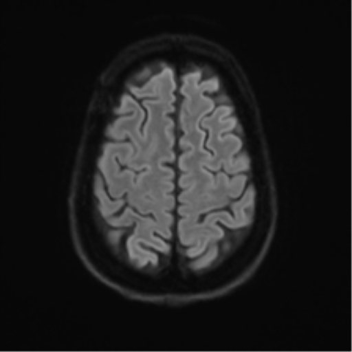 File:Acute disseminated encephalomyelitis (ADEM) (Radiopaedia 65319-74350 Axial DWI 27).png
