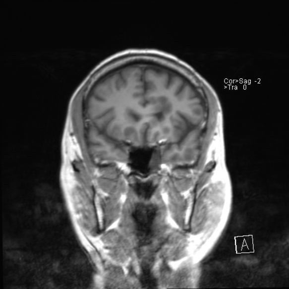 File:Acute disseminated encephalomyelitis (Radiopaedia 37253-39033 Coronal T1 10).jpg