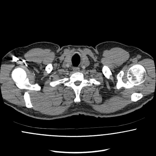 Acute epicardial fat necrosis (Radiopaedia 42327-45440 Axial C+ CTPA 9).jpg
