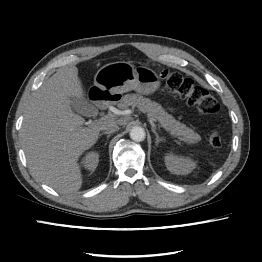 Acute epicardial fat necrosis (Radiopaedia 42327-45440 Axial C+ CTPA 92).jpg