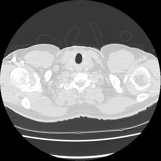 Acute epicardial fat necrosis (Radiopaedia 42327-45440 Axial lung window 4).jpg