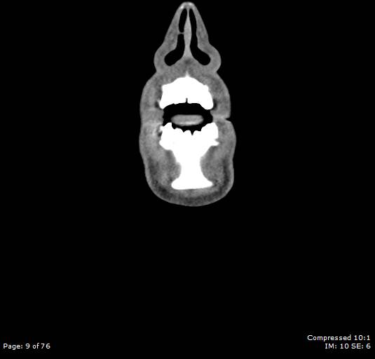 Acute epiglottitis (Radiopaedia 54375-60590 Coronal C+ arterial phase 9).jpg