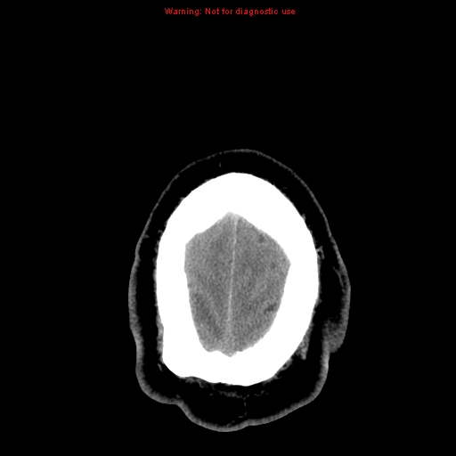 Acute hemorrhagic leukoencephalitis (Radiopaedia 14076-13920 Axial non-contrast 47).jpg