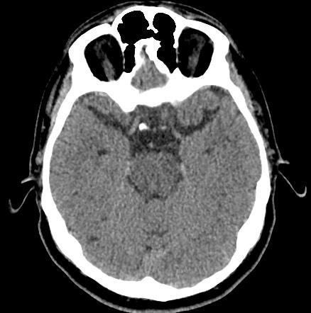 Acute internal carotid artery dissection (Radiopaedia 53541-59558 Axial non-contrast 21).jpg