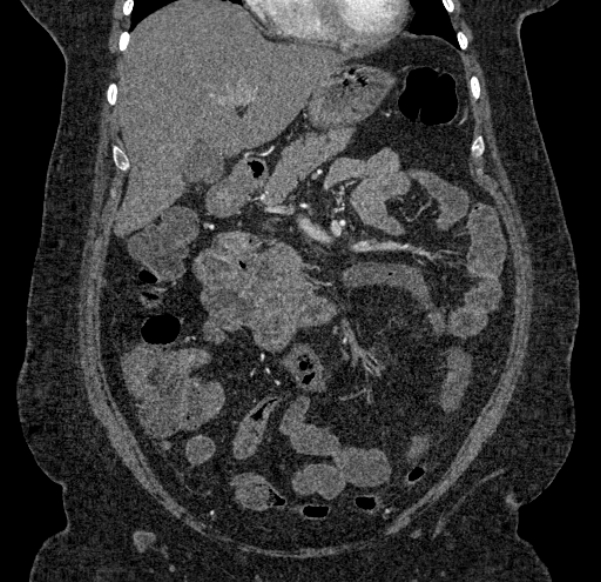 Acute mesenteric ischemia (Radiopaedia 80029-93316 Coronal C+ arterial phase 47).jpg