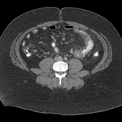 Acute mesenteric venous ischemia (Radiopaedia 46041-50383 Axial C+ portal venous phase 80).jpg
