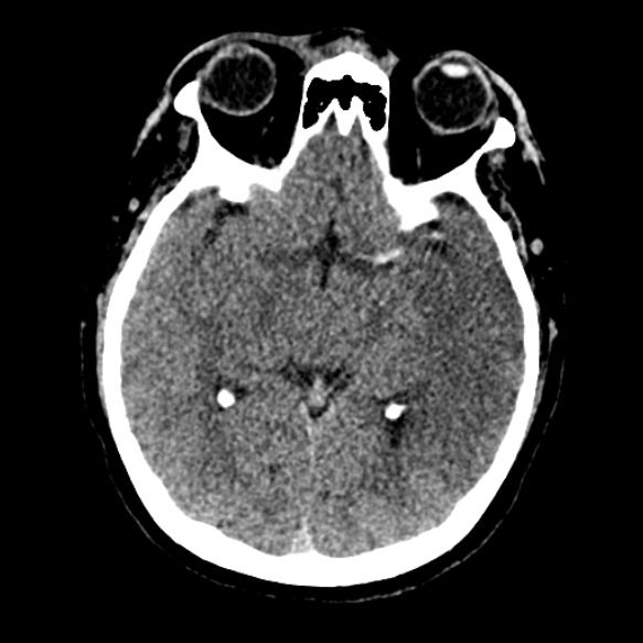 Acute middle cerebral artery territory infarct (Radiopaedia 52380-58283 Axial non-contrast 45).jpg