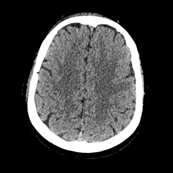 Acute middle cerebral artery territory infarct (Radiopaedia 52380-58283 Axial non-contrast 76).jpg