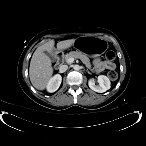 File:Acute myocardial infarction in CT (Radiopaedia 39947-42415 Axial C+ portal venous phase 45).jpg