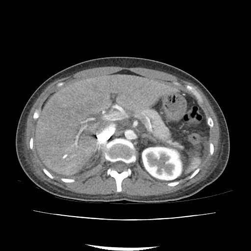 Acute myocarditis (Radiopaedia 55988-62613 Axial C+ portal venous phase 23).jpg